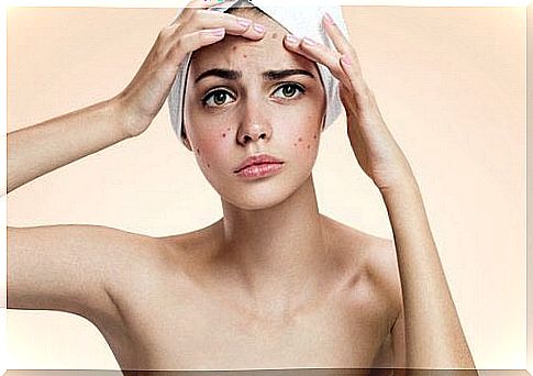 woman with acne