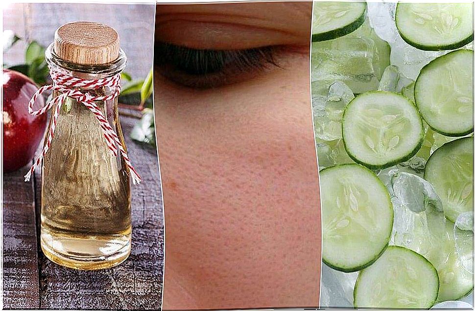 6 Natural Remedies You Can Use to Close Open Pores