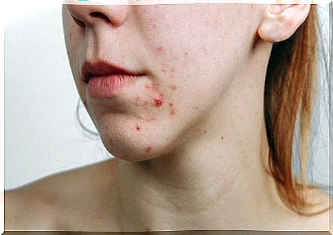 woman with acne on the face