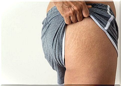 Almond oil is beneficial for stretch marks