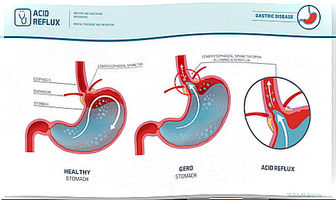 Diet for gastroesophageal reflux 