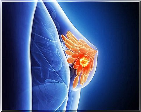 Flax Seeds to Prevent Breast Cancer