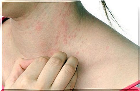 urticaria