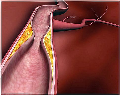 arteriosclerosis