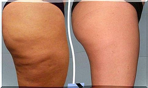 The best natural treatments against cellulite