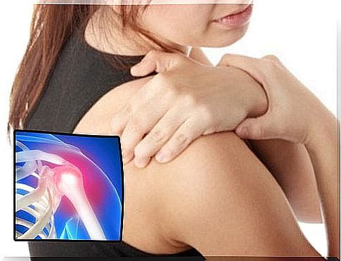 Woman with shoulder pain due to capsulitis